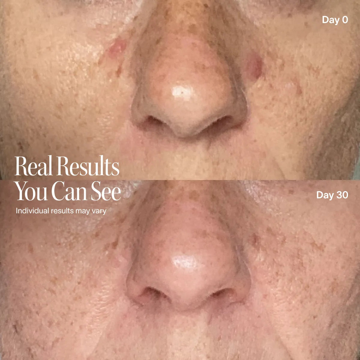 Close-up before and after images of a nose and upper lip show fewer blemishes and smoother skin after 30 days using the Solawave Wrinkle Retreat Pro LED Face Mask with Red, Infrared, Deep Red, and Amber Light Therapy. Individual results may vary.
